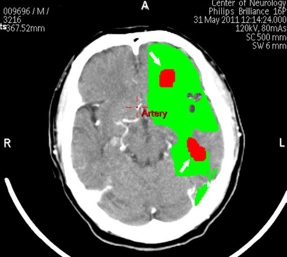 Персональный сайт - Шунтирование артерий головного мозга